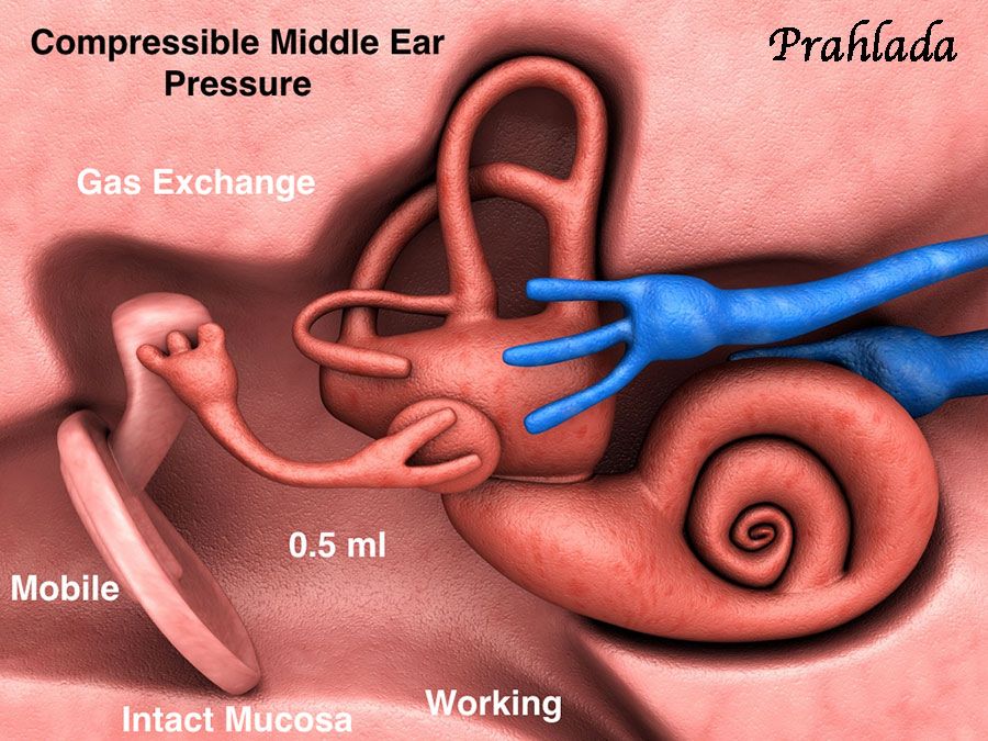 A picture illustration by me to illustrate compressible middle ear pressure. 